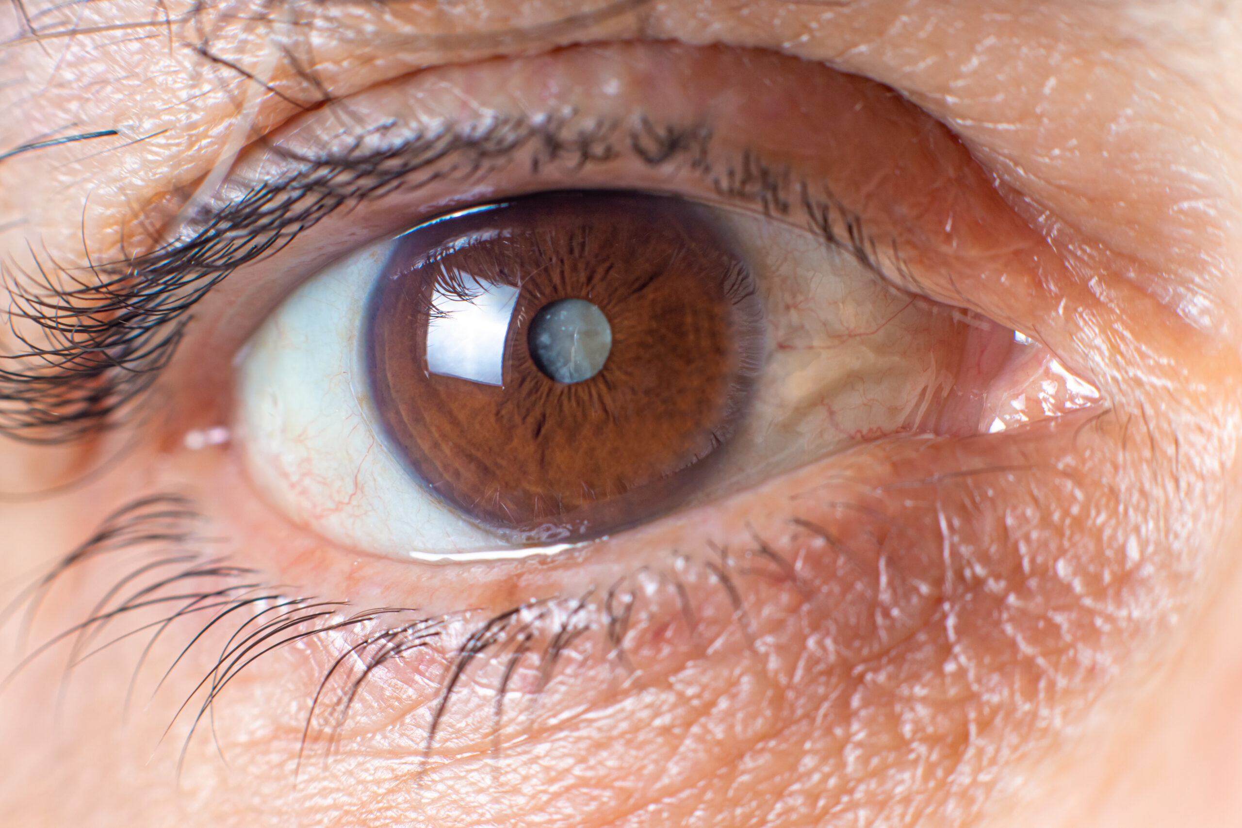 Cataract
