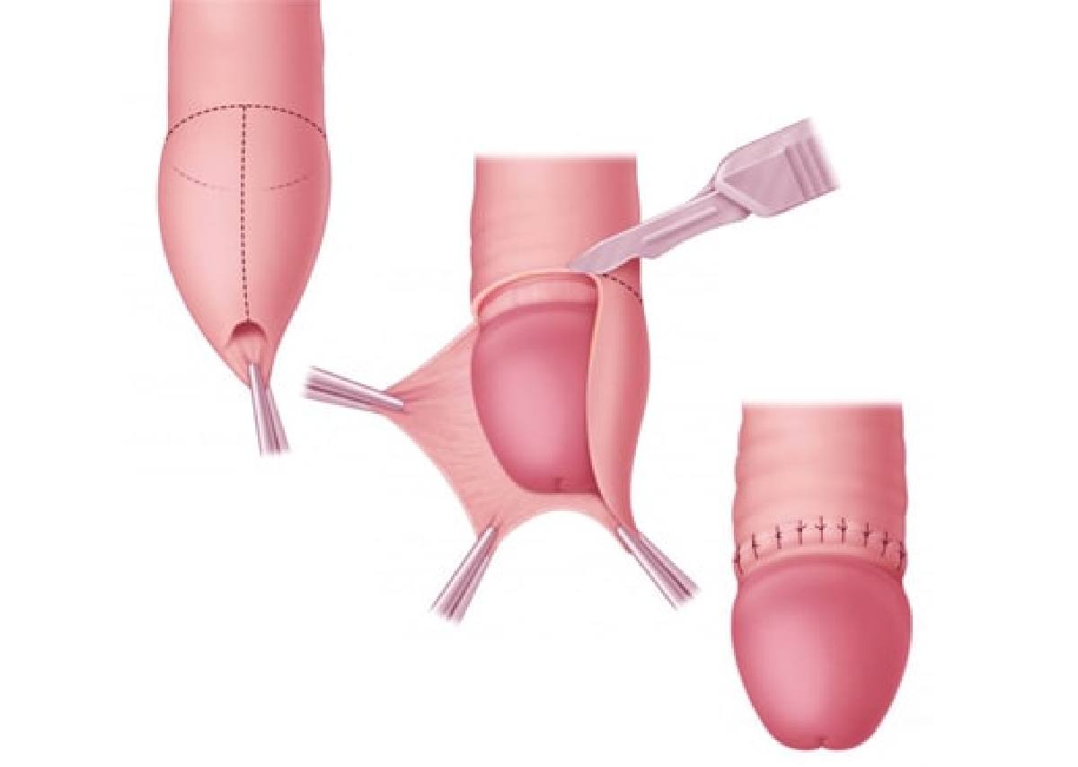 Circumcision