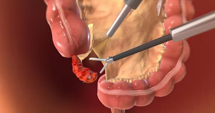Laparoscopic Appendectomy