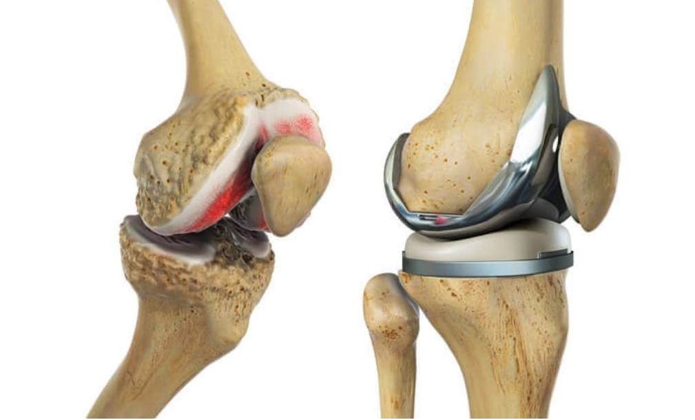 Unilateral total knee replacement