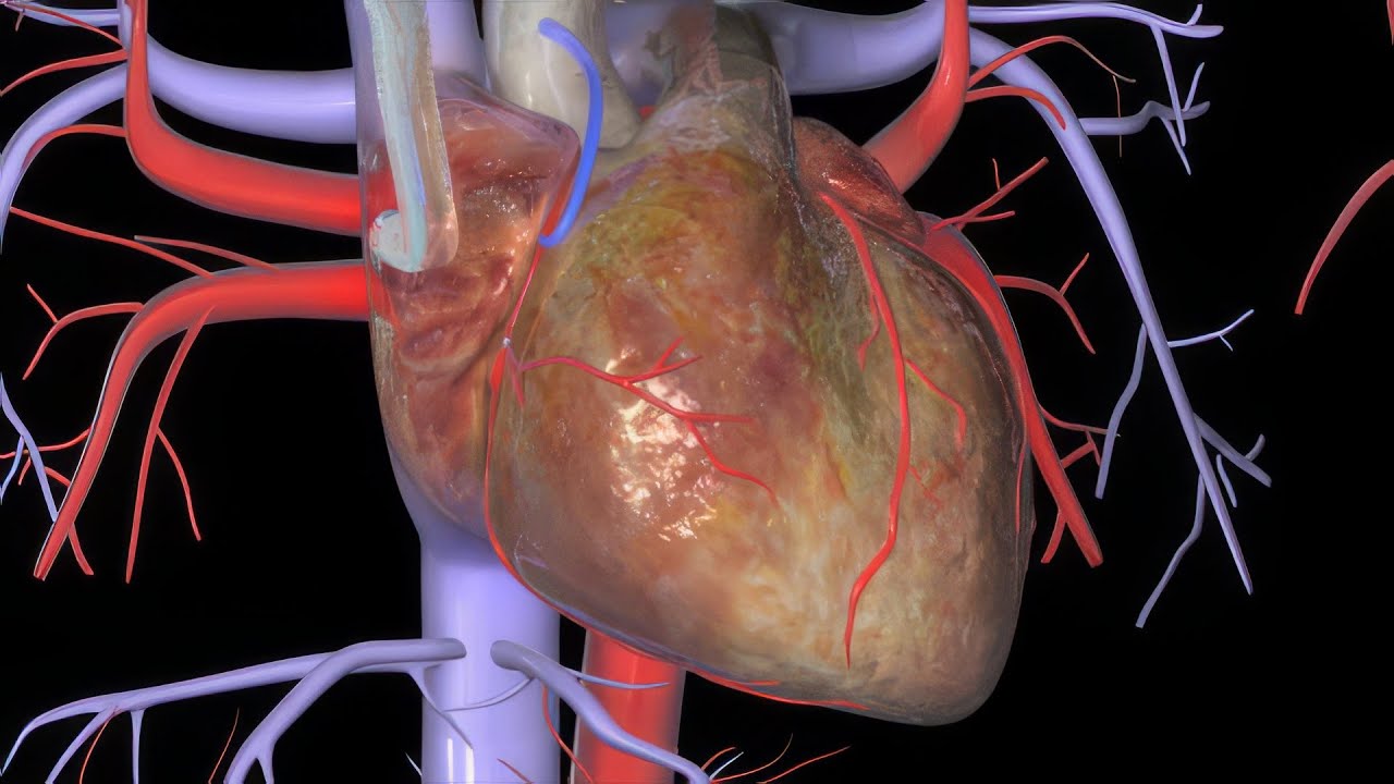 Heart bypass surgery