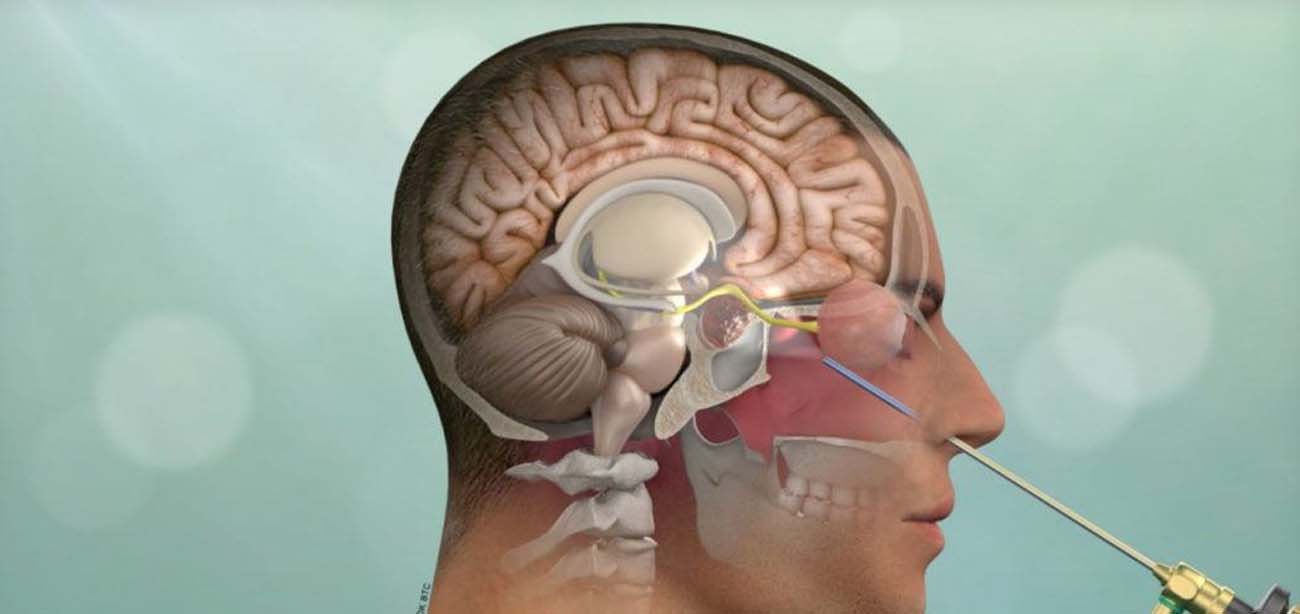 Craniotomy