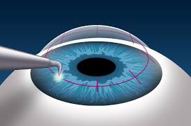 Cornea Transplant