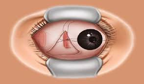 Squint Surgery