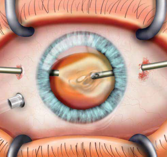 Vitrectomy