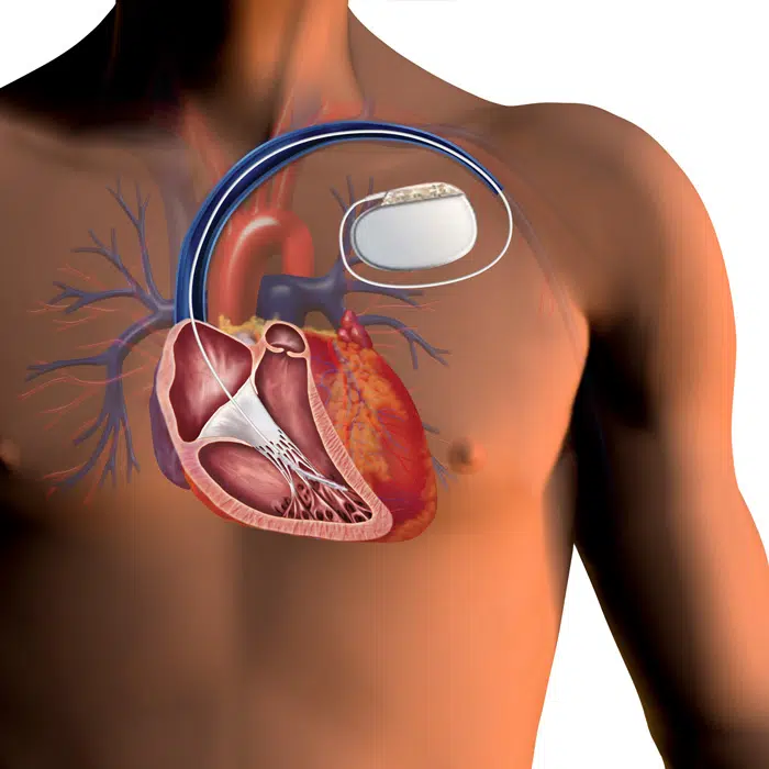 ICD implantation
