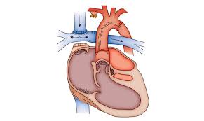 Glenn procedure