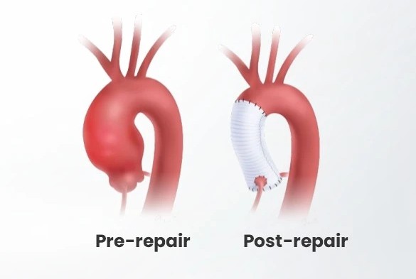 Bentall surgery