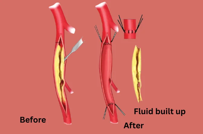 Coronary endarterectomy