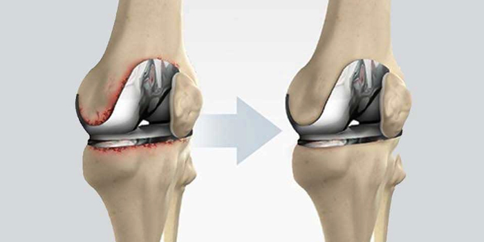 Joint revision surgery