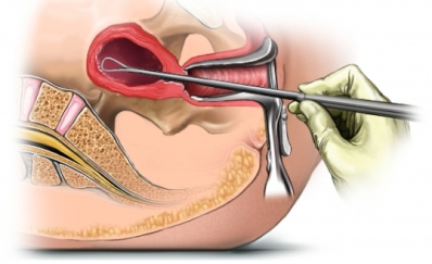 Dilation and Curettage (D&C)