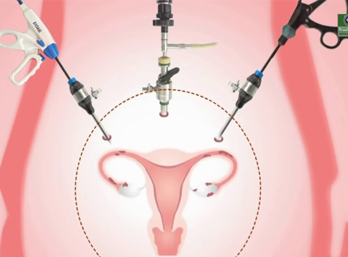 Total Laparoscopic Hysterectomy