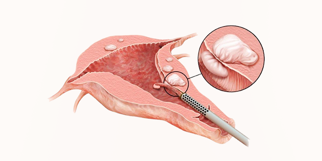 Laparoscopic Myomectomy