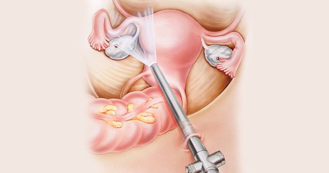 Laparoscopic Endometriosis Surgery