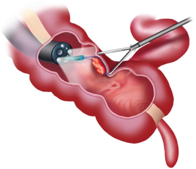 Laparoscopic Polypectomy