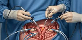 Laparoscopic Oophorectomy