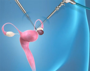 Laparoscopic Cystectomy