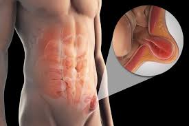 Hernias
