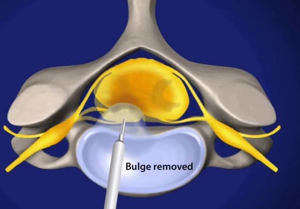 Discectomy