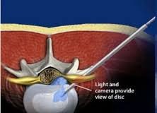 Discectomy