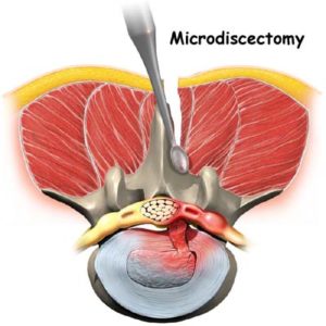 Microdiscectomy