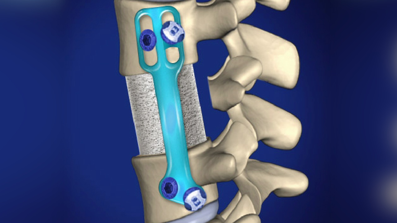 Corpectomy