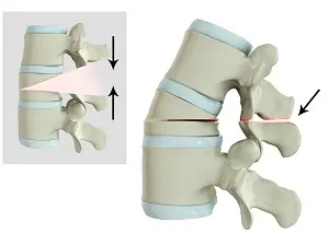 Spinal Osteotomy