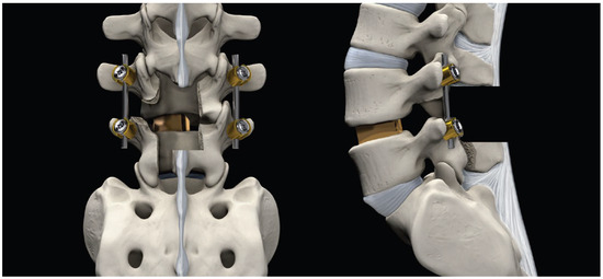 Spinal fusion