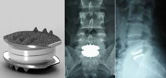 Artificial disc replacement