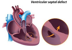 VSD