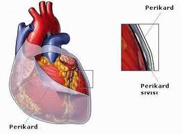 Pericardiectomy