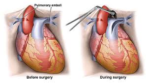 Pulmonary thromboendarterectomy